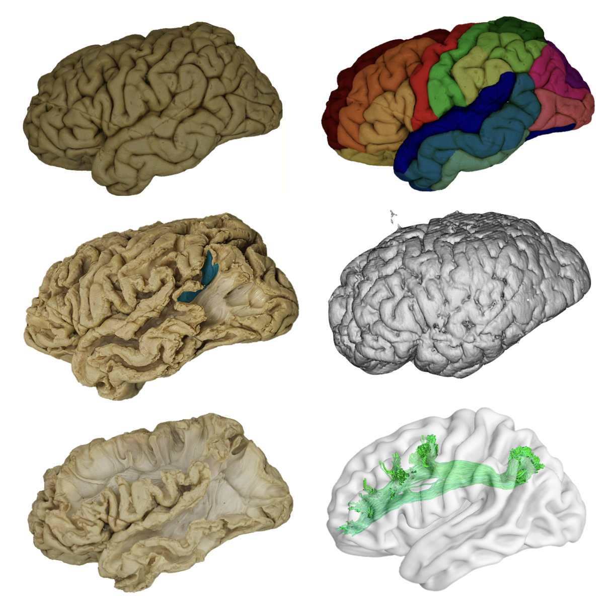 BraDiPho - Brain Dissection Photogrammetry and Tractography