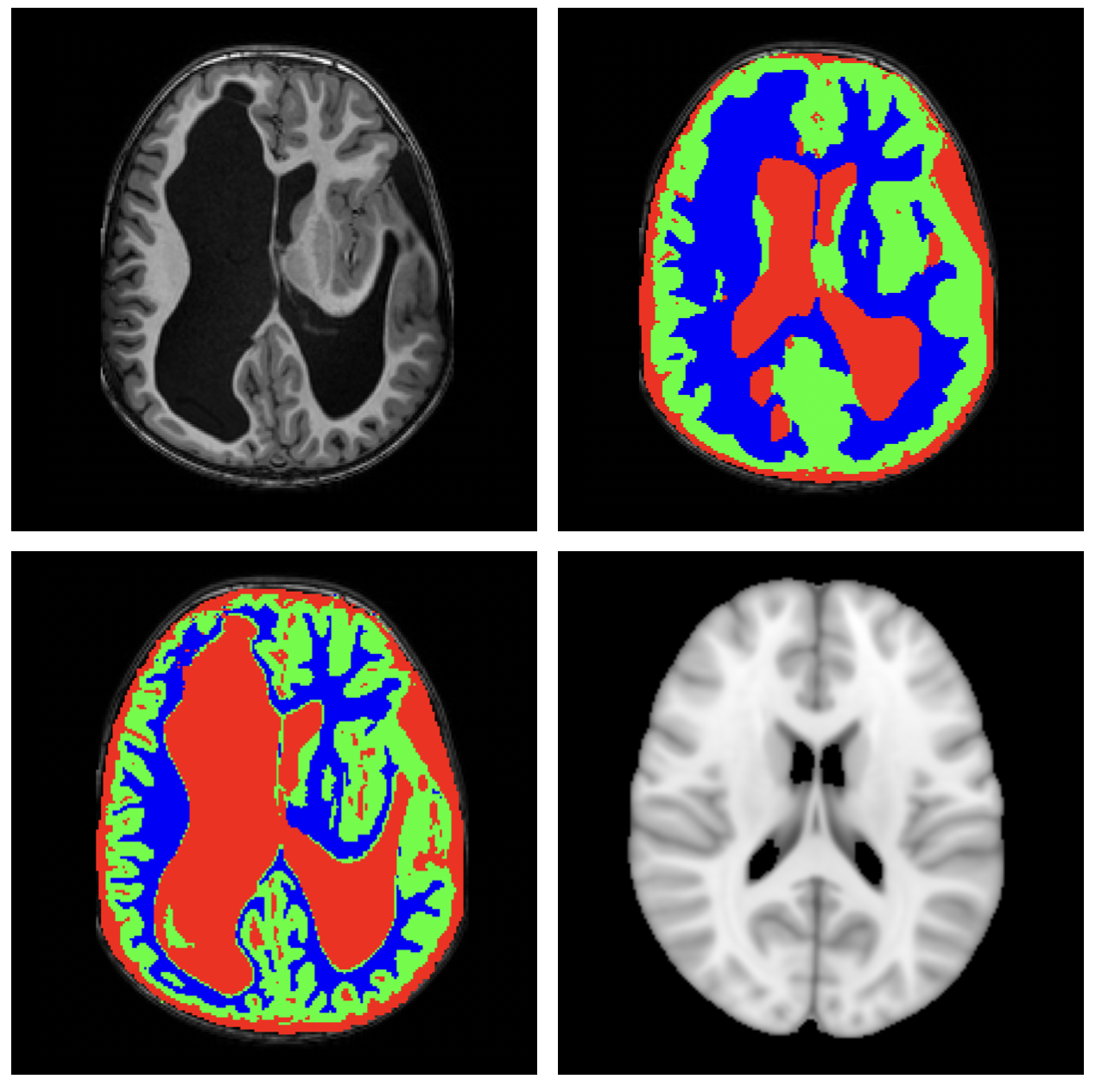 DBB - Paediatric Distorted Brains Benchmark