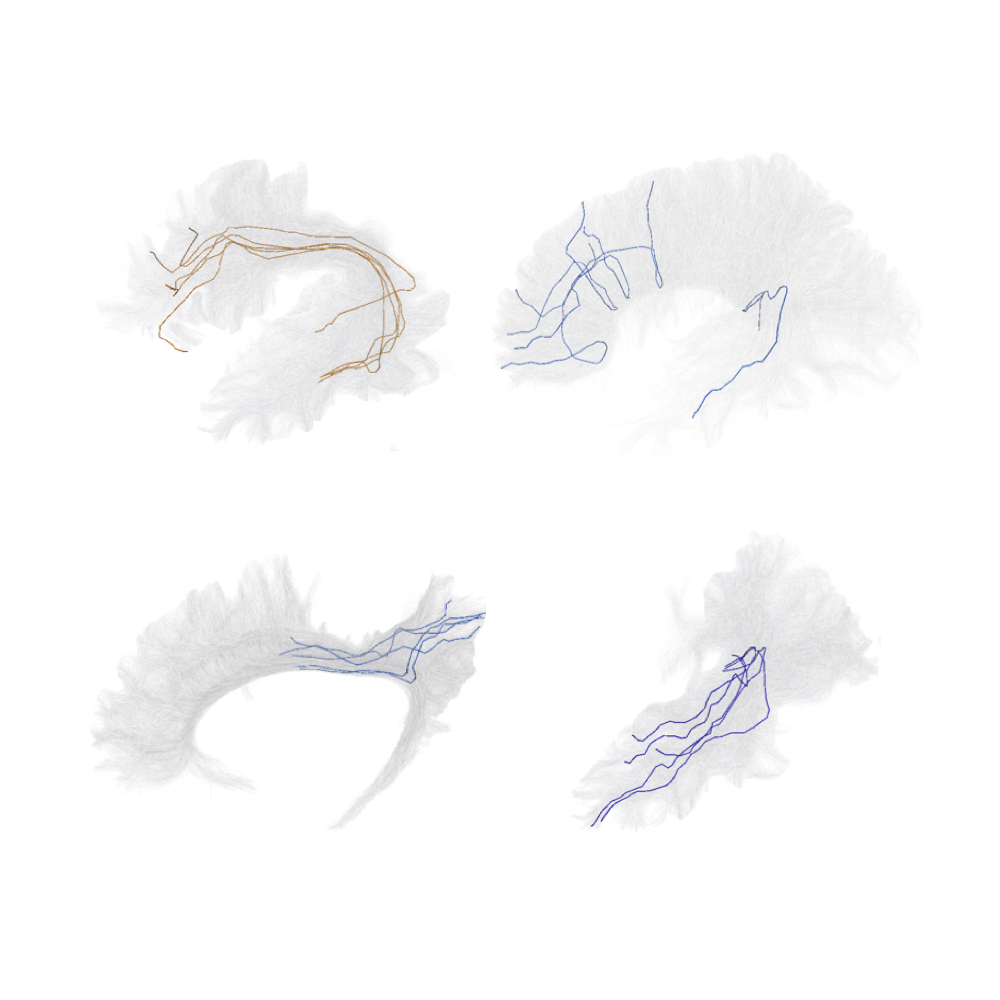 ARTRACK - Artifactual tracks in human brain tractograms