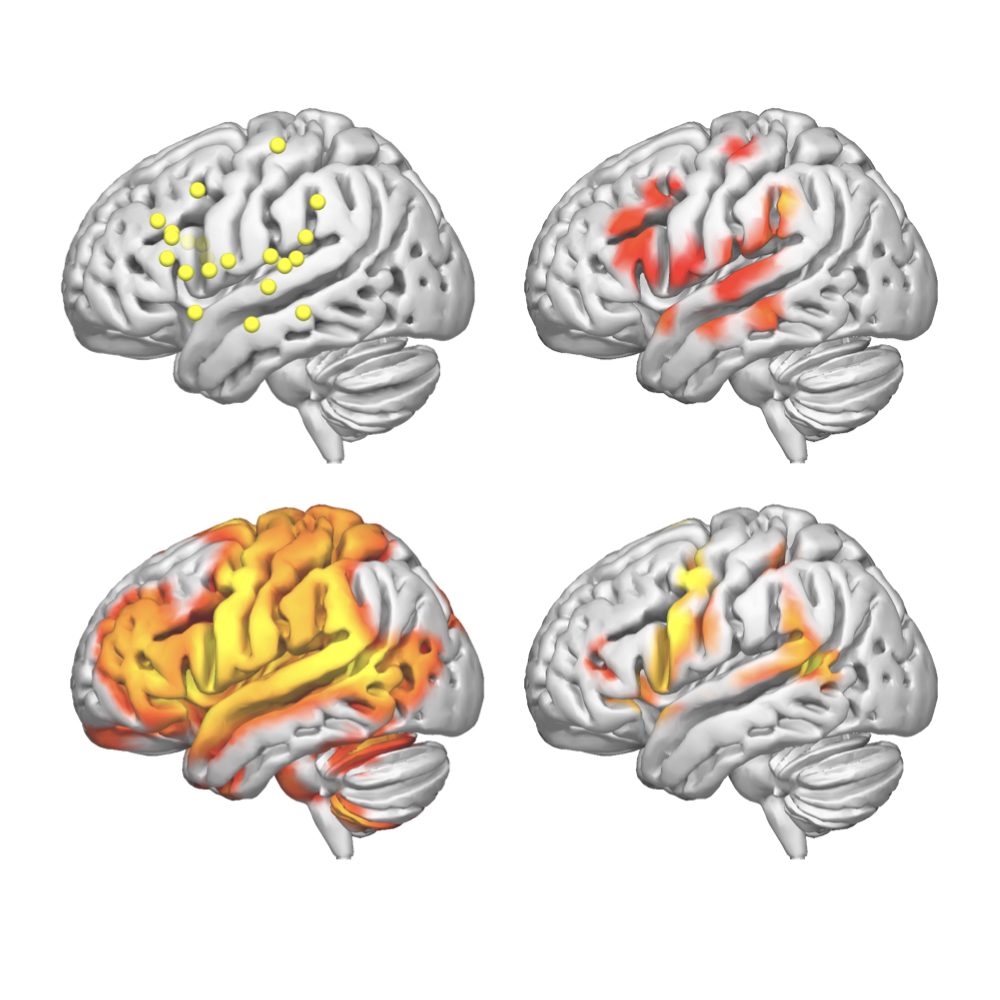 Direct Electrical Stimulation and neurological monitoring in awake surgery